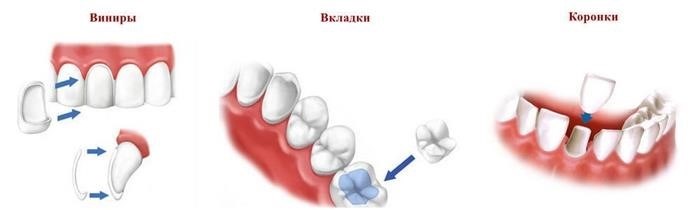 Варианты протезирования возможны после установки протеза и удаления корней