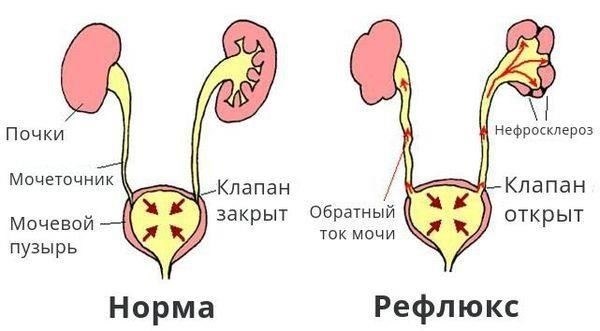 Рефлюксная уропатия: Диагностика и профилактические мерыДля пациентов с рефлюкс-уропатией ключевое значение имеет ранняя диагностика и соответствующее вмешательство. Это состояние, при котором происходит аномальный обратный ток мочи в почки, часто приводит к вторичному повреждению почек. Если не принять должных мер, это может привести к хроническому пиелонефриту, гидронефрозу и даже почечной недостаточности.